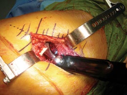 surgery for hip labrum
